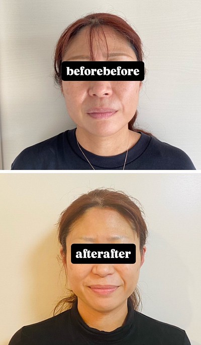 1回でもかなりの変化ですが、続ける事で効果抜群！！顔全体が整ってきます。